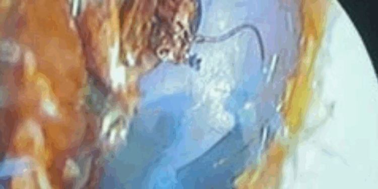 استخراج صرصور من أذن شاب بالقليوبية.. وتحذيرات طبية للتعامل مع دخول الحشرات للأذن