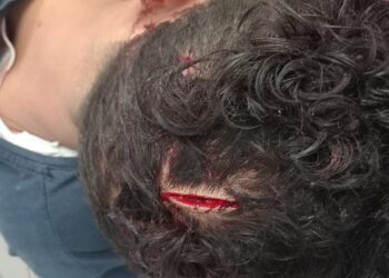 إصابة شاب بجرح قطعي بفروة الرأس وجرح بالكتف في تعدٍ بالعمرانية