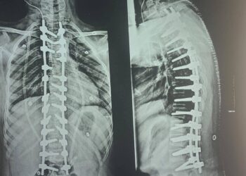 بعملية جراحية دقيقة.. مستشفى الأزهر بأسيوط تُصحح اعوجاج بالعمود الفقري لطفلة