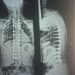 بعملية جراحية دقيقة.. مستشفى الأزهر بأسيوط تُصحح اعوجاج بالعمود الفقري لطفلة